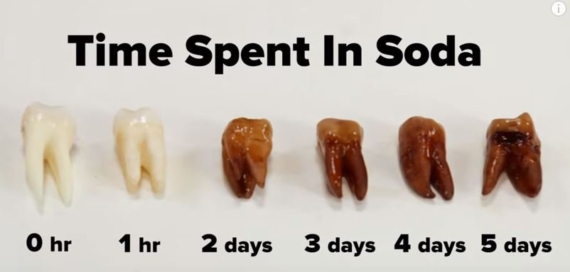 when-can-i-drink-soda-after-wisdom-teeth-removal_1751907113