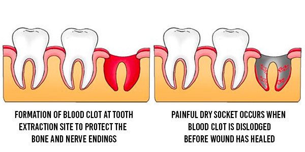 when-can-i-vape-after-tooth-extraction_1751908988
