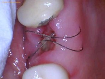 when-do-wisdom-teeth-stitches-dissolve_1751905584